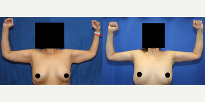 Case: 6914 - before and after photo of 45-54 year old woman treated with Arm Lift by J. Timothy Katzen, MD, FACS