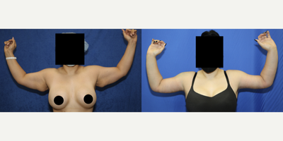 Case: 6915 - before and after photo of 35-44 year old woman treated with Arm Lift by J. Timothy Katzen, MD, FACS