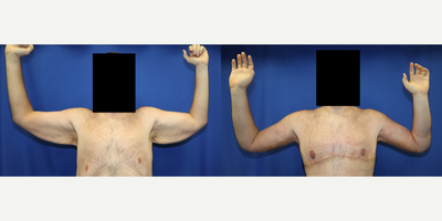 Case: 6916 - before and after photo of 25-34 year old man treated with Arm Lift by J. Timothy Katzen, MD, FACS