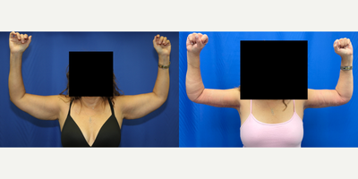 Case: 6917 - before and after photo of 45-54 year old woman treated with Arm Lift by J. Timothy Katzen, MD, FACS