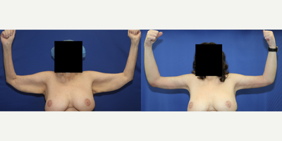 Case 6918 - 55-64 year old woman treated with Arm Lift