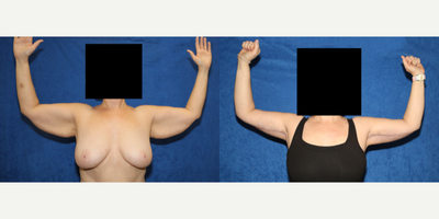 Case 6919 - 45-54 year old woman treated with Arm Lift