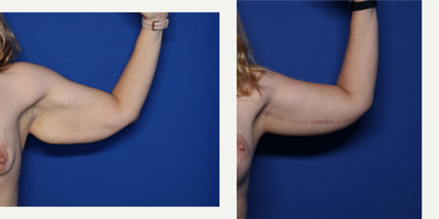 Case 6920 - 35-44 year old woman treated with Arm Lift