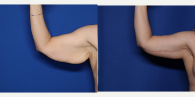 Case 6921 - 35-44 year old woman treated with Arm Lift