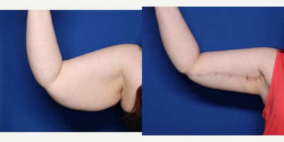 Case 6923 - 25-34 year old woman treated with Arm Lift