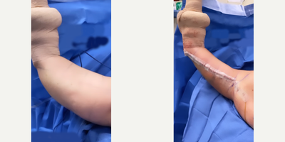 Case 6924 - 55-64 year old woman treated with Arm Lift