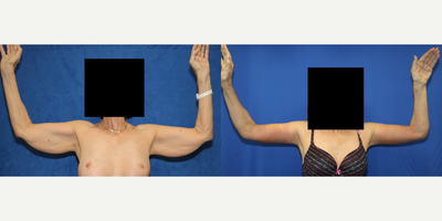 Case 6925 - 65-74 year old woman treated with Arm Lift