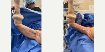 Case 6926 - 55-64 year old woman treated with Arm Lift