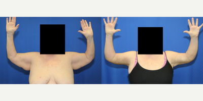 Case 6927 - 65-74 year old woman treated with Arm Lift