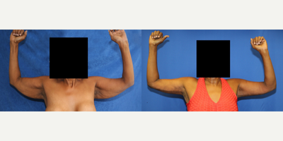 Case 6928 - 55-64 year old woman treated with Arm Lift