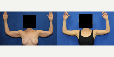 Case 6929 - 35-44 year old woman treated with Arm Lift