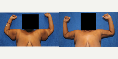 Case 6930 - 35-44 year old woman treated with Arm Lift