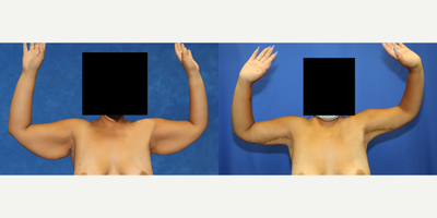 Case 6931 - 25-34 year old woman treated with Arm Lift