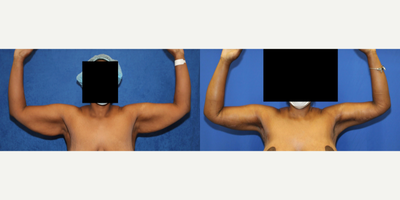 Case 6932 - 35-44 year old woman treated with Arm Lift