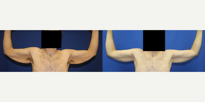 Case 6933 - 25-34 year old man treated with Arm Lift