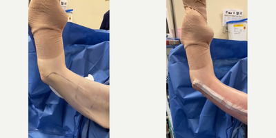 Case 6934 - 45-54 year old woman treated with Arm Lift