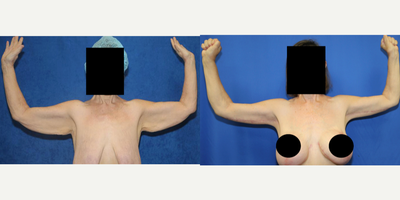 Case 6936 - 55-64 year old woman treated with Arm Lift