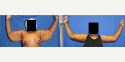 Case 6937 - 35-44 year old woman treated with Arm Lift