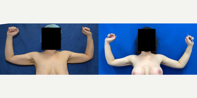 Case 6938 - 25-34 year old woman treated with Arm Lift