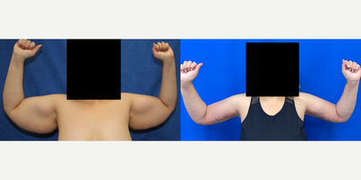 Case 6939 - 35-44 year old woman treated with Arm Lift