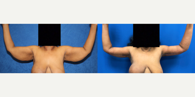 Case 6940 - 45-54 year old woman treated with Arm Lift