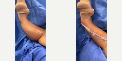 Case 6941 - Arm Lift, Liposuction