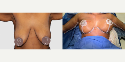 Case 6942 - Arm Lift