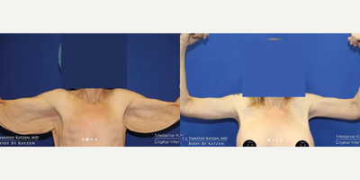 Case 6943 - 35-44 year old woman treated with Arm Lift