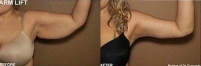 Case 6944 - Woman treated with Arm Lift