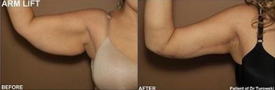 Case 6945 - Woman treated with Arm Lift