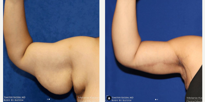 Case 6946 - 35-44 year old woman treated with Arm Lift