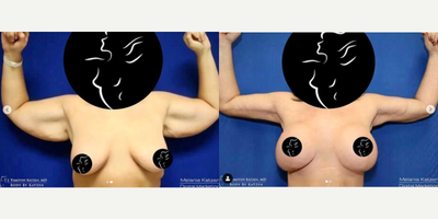 Case 6947 - 25-34 year old woman treated with Arm Lift