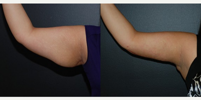 Case 6948 - Woman treated with Arm Lift