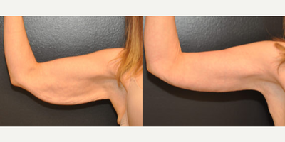 Case 6949 - 42 year old woman treated with Arm Lift