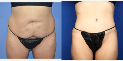 Case 695 - 25-34 year old woman treated with Tummy Tuck