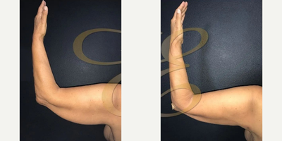 Case 6959 - Woman treated with Arm Lift