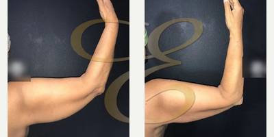 Case 6960 - Woman treated with Arm Lift