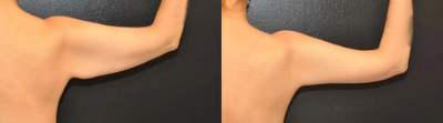 Case 6963 - 34 year old woman treated with Arm Lift, Liposuction