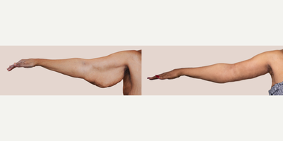 Case 6966 - 65-74 year old woman treated with Arm Lift