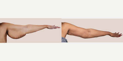 Case 6967 - 65-74 year old woman treated with Arm Lift