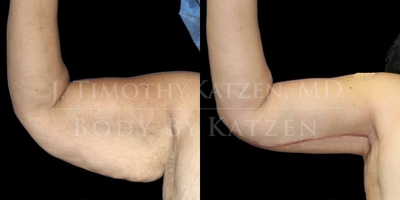 Case 6971 - Arm Lift