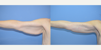 Case 6973 - 45-54 year old woman treated with Arm Lift