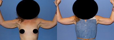 Case 6975 - 25-34 year old woman treated with Arm Lift