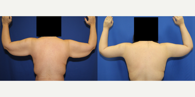 Case 6976 - 35-44 year old woman treated with Arm Lift