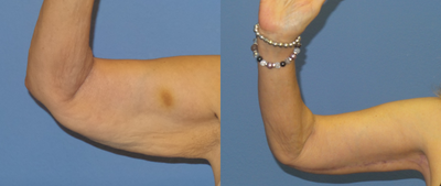 Case 6977 - 65-74 year old woman treated with Arm Lift