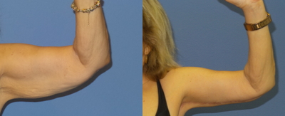 Case 6978 - 65-74 year old woman treated with Arm Lift