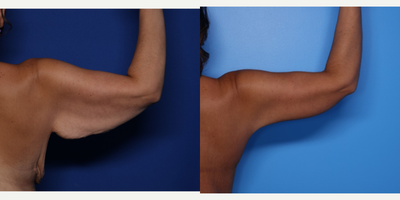 Case 6979 - 35-44 year old woman treated with Arm Lift