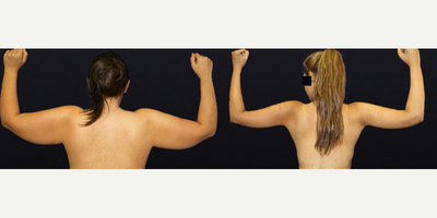 Case 6981 - Woman treated with Arm Lift