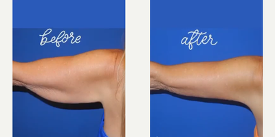 Case 6982 - Woman treated with Arm Lift