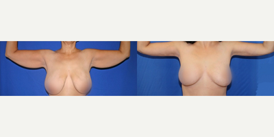 Case 6983 - Arm Lift